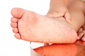 periode de contagion pied main bouche periode de contagion pied main bouche
