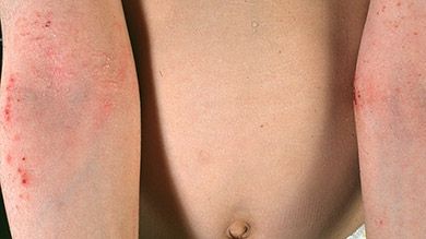 Lhormone de la croissance du psoriasis